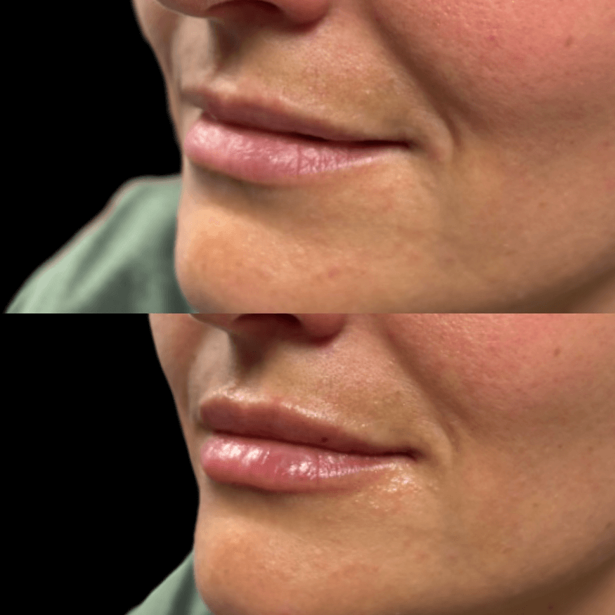 beforeafterbacio